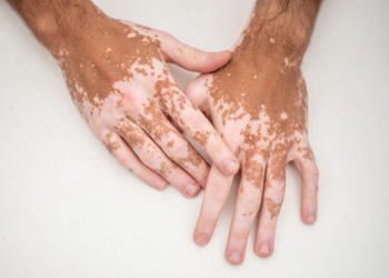 Psoriasis and Leukoderma